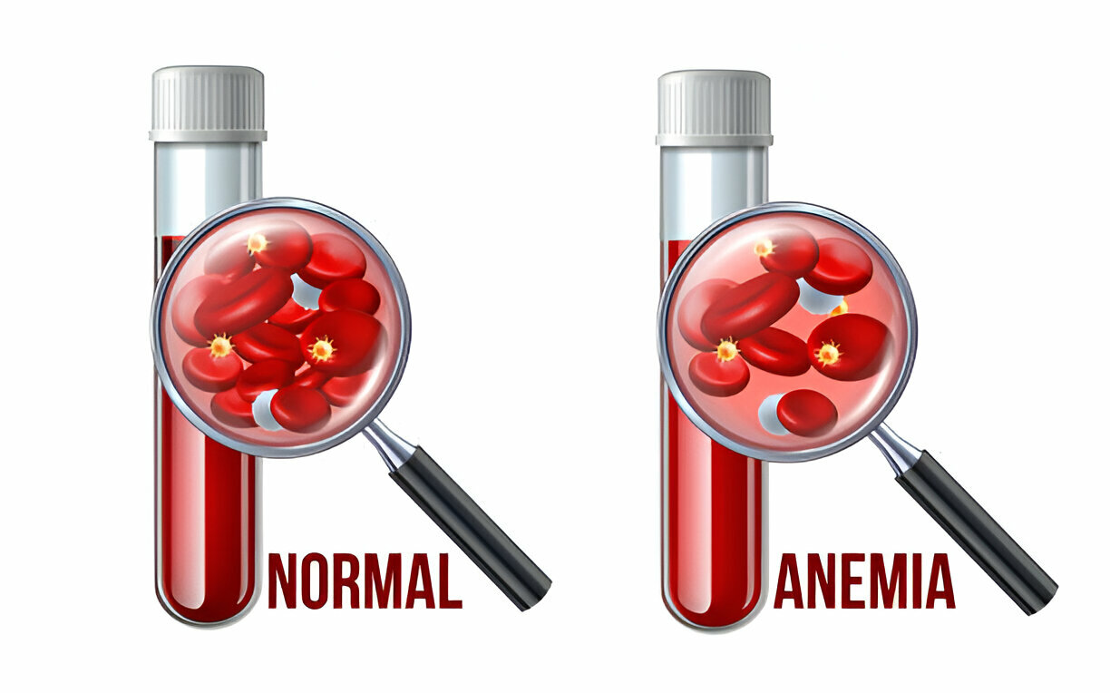 Anemia