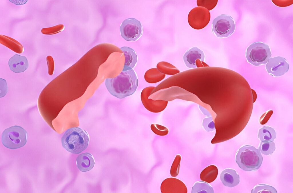 Hemolytic Anemia